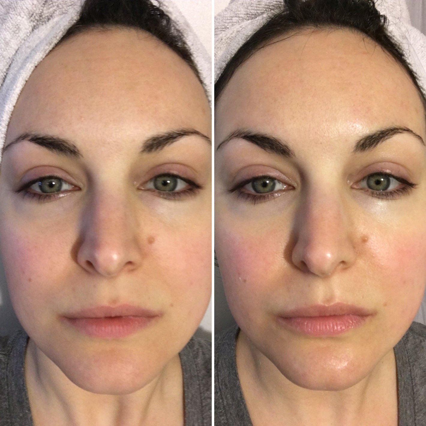 deep collagen retinol lift-up mask 22 Before and After CO2 Lift
